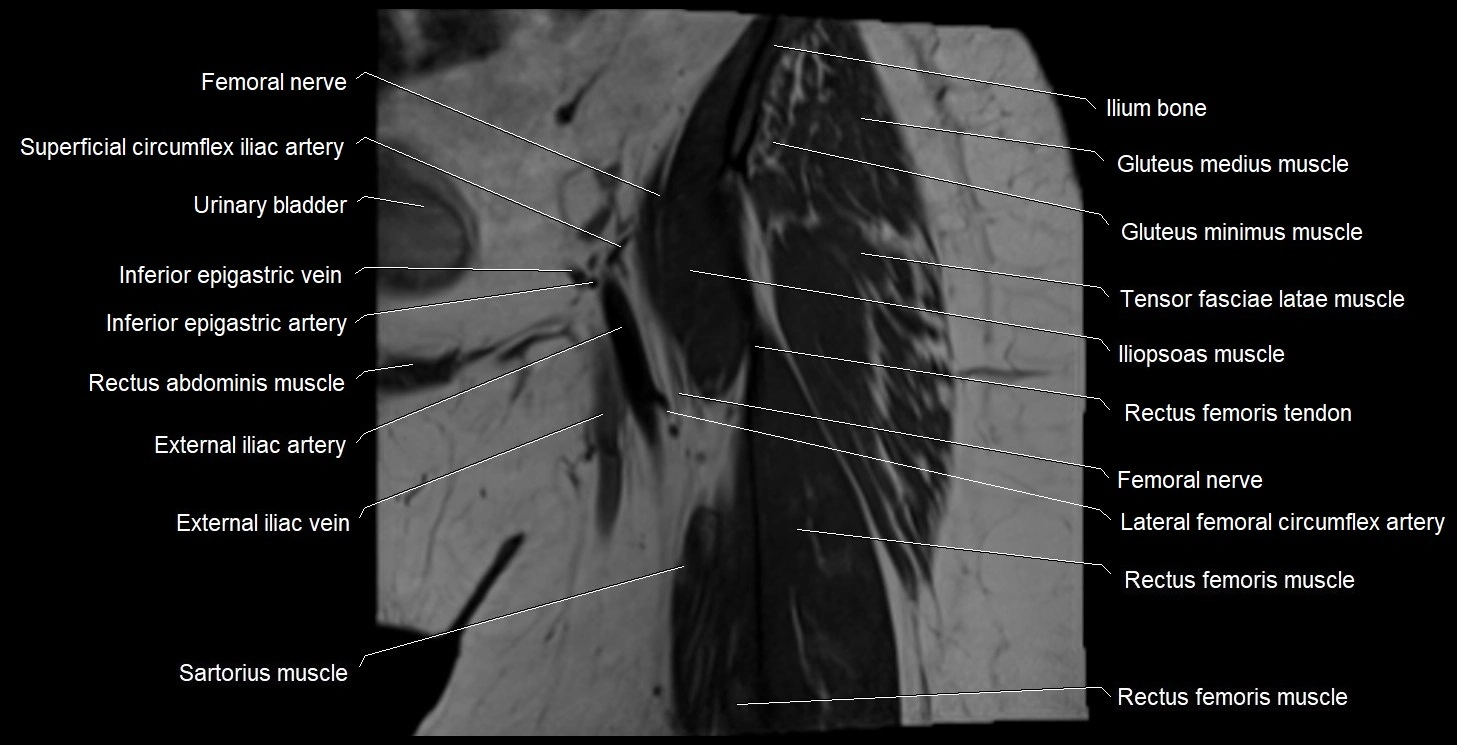 MRI Hip 3T coronal cross sectional anatomy image 8.webp